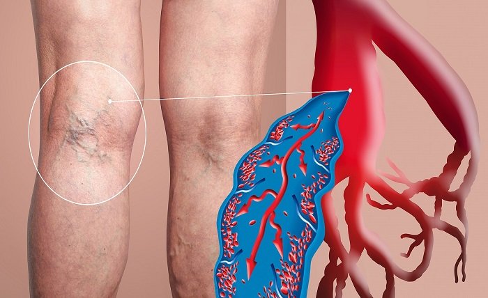 Vein Thrombosis